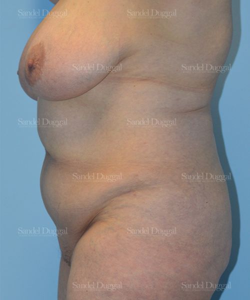 Tummy Tuck before, case 1533