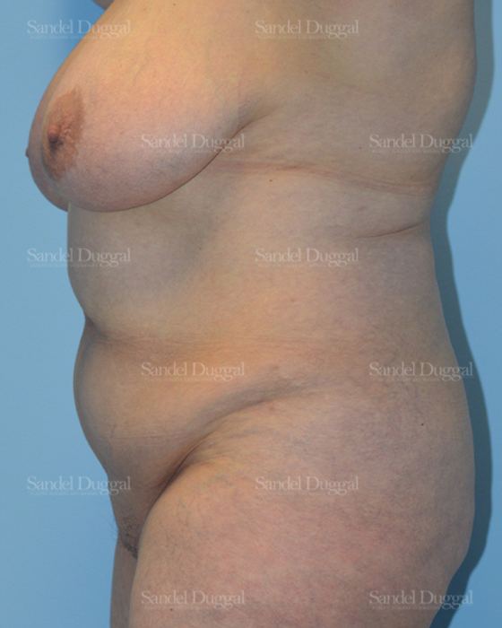 Tummy Tuck before, case 1533