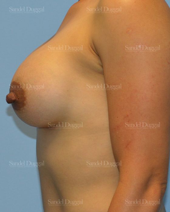 Breast Augmentation after, case 3255