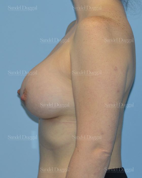 Breast Augmentation after, case 3066