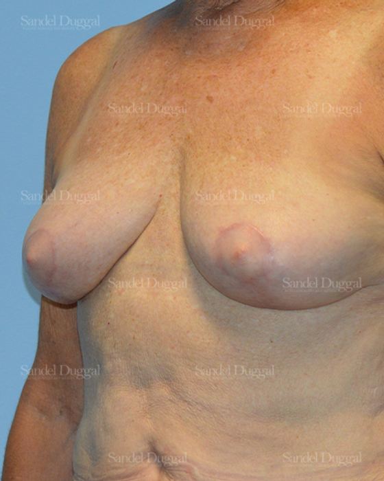 Breast Lift after, case 3315
