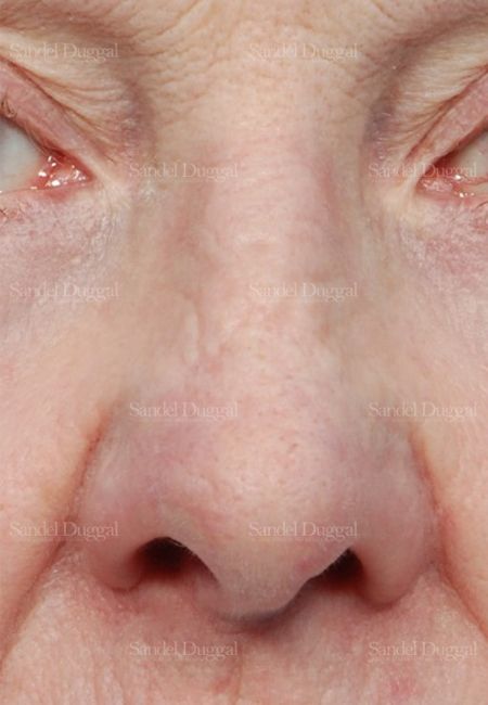 Revision Rhinoplasty after, case 2614