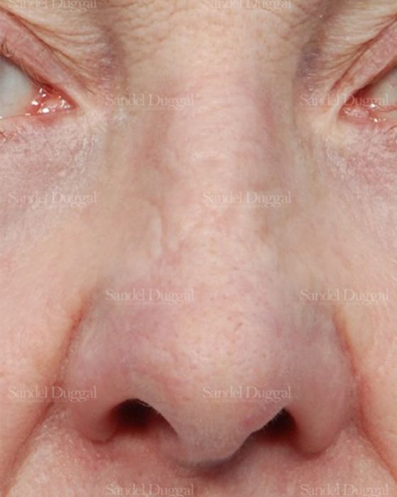 Revision Rhinoplasty after, case 2614
