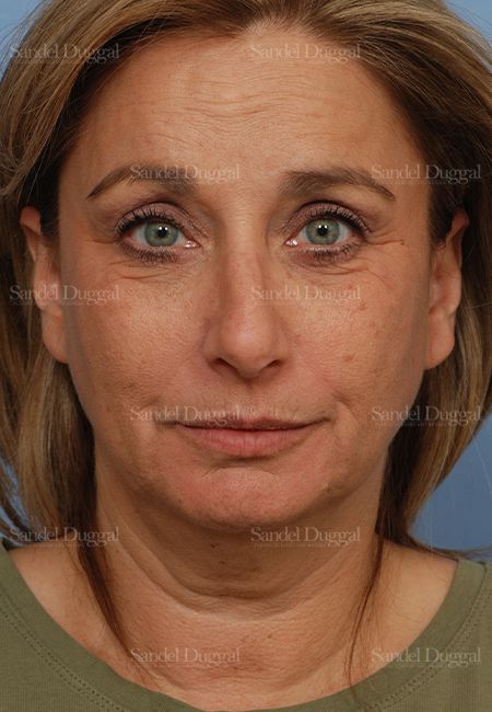 Facelift before, case 2714