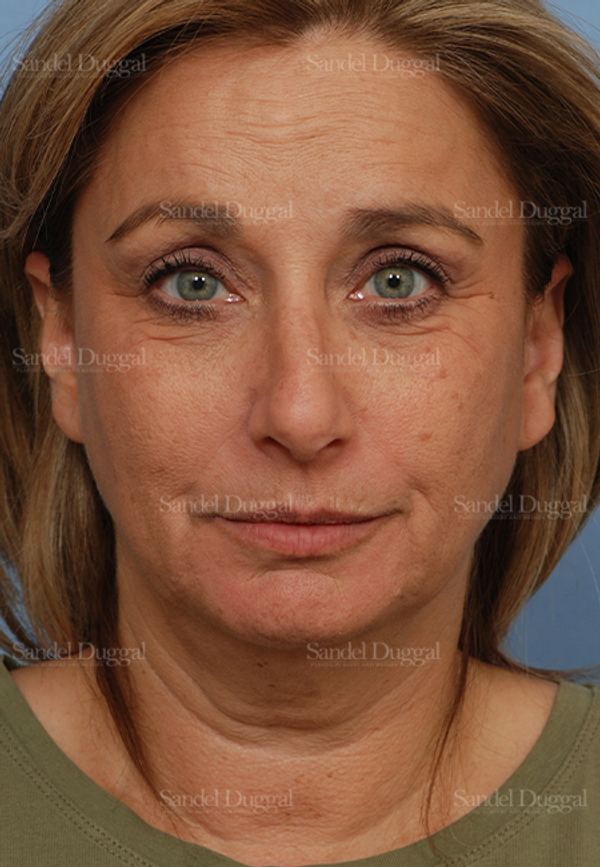 Facelift before, case 2714