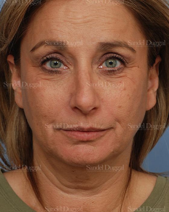 Facelift before, case 2714