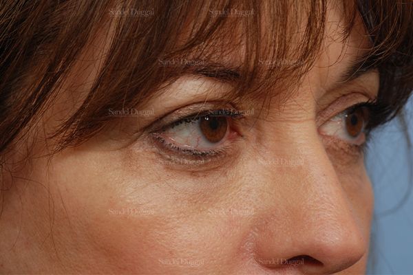 Eyelid Rejuvenation after, case 831