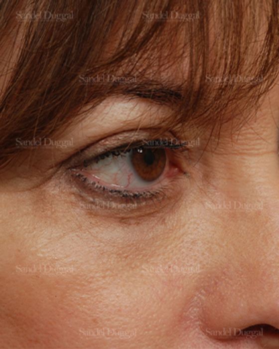 Eyelid Rejuvenation after, case 831