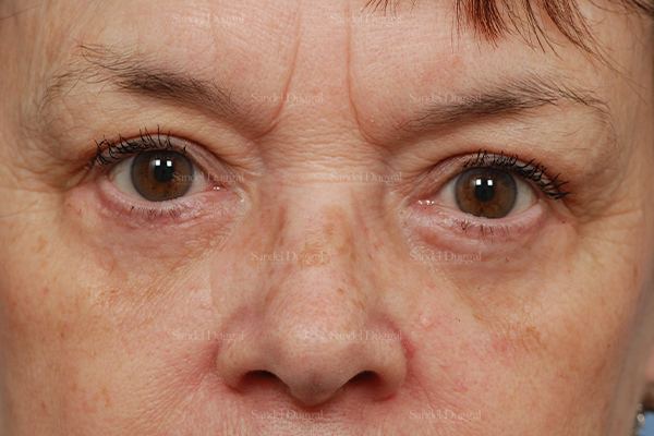 Eyelid Rejuvenation after, case 1976