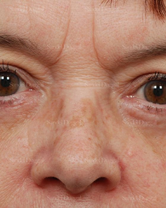 Eyelid Rejuvenation after, case 1976