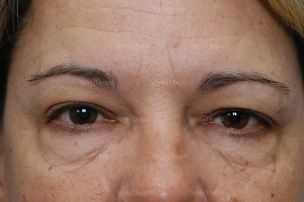 Eyelid Rejuvenation before, case 1900