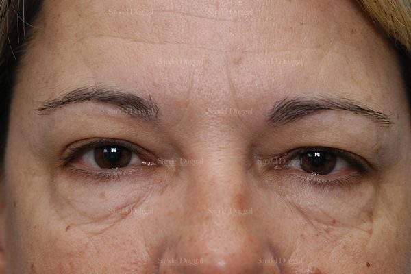 Eyelid Rejuvenation before, case 1900