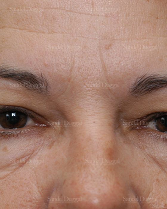 Eyelid Rejuvenation before, case 1900
