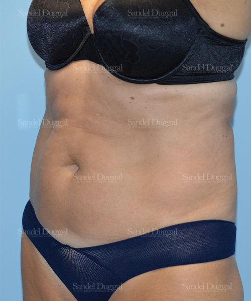 Tummy Tuck before, case 1636