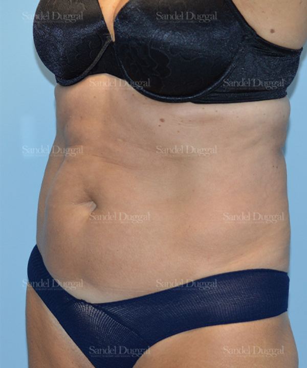 Tummy Tuck before, case 1636