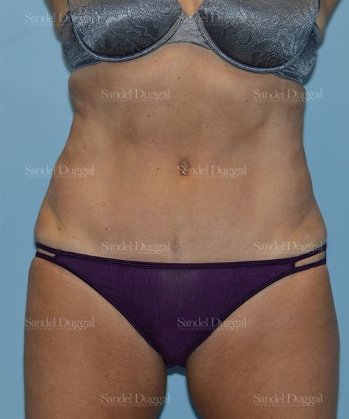 Tummy Tuck after, case 1636