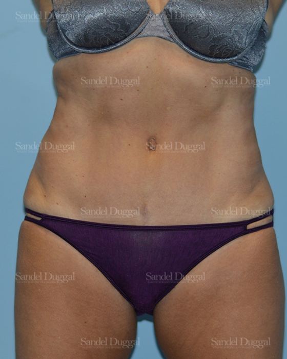 Tummy Tuck after, case 1636