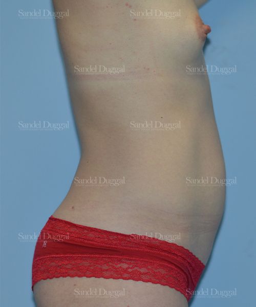 Tummy Tuck before, case 1554