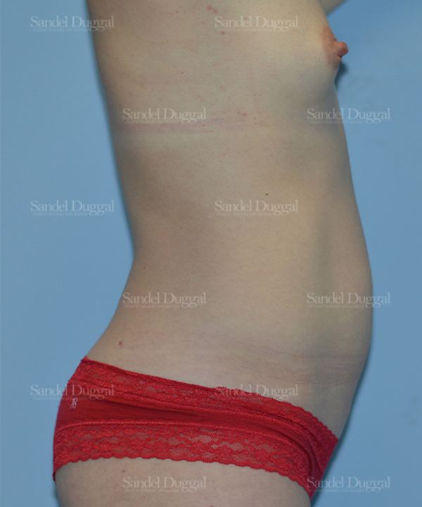 Tummy Tuck before, case 1554
