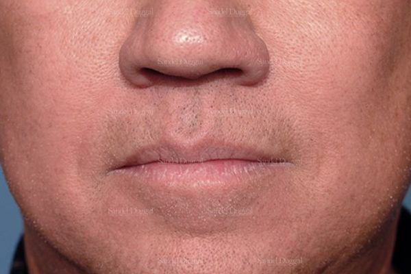 Botox & Fillers after, case 2591