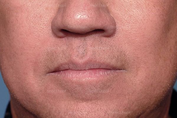 Botox & Fillers after, case 2591