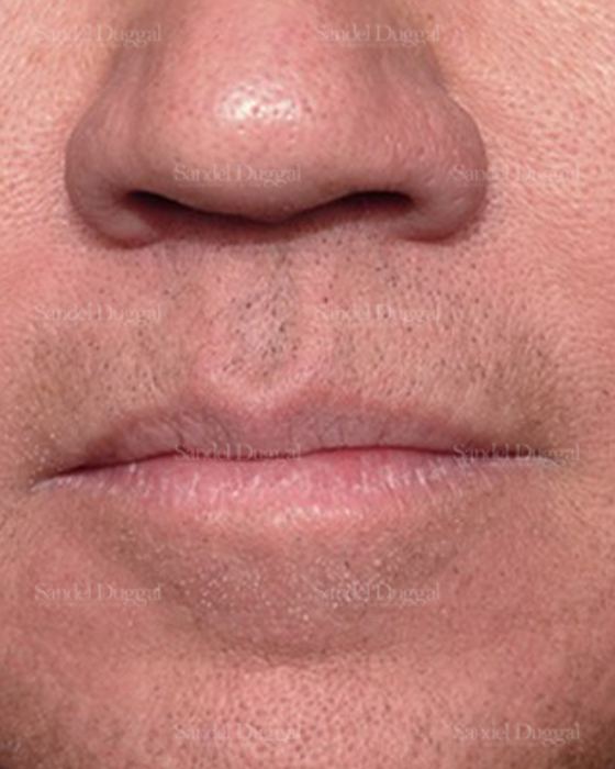 Botox & Fillers after, case 2591