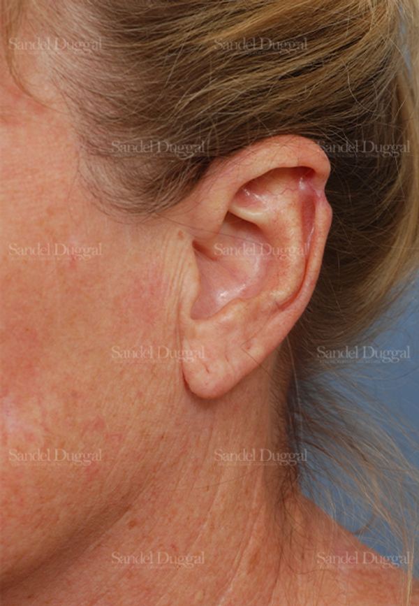 Scar Revision before, case 2570