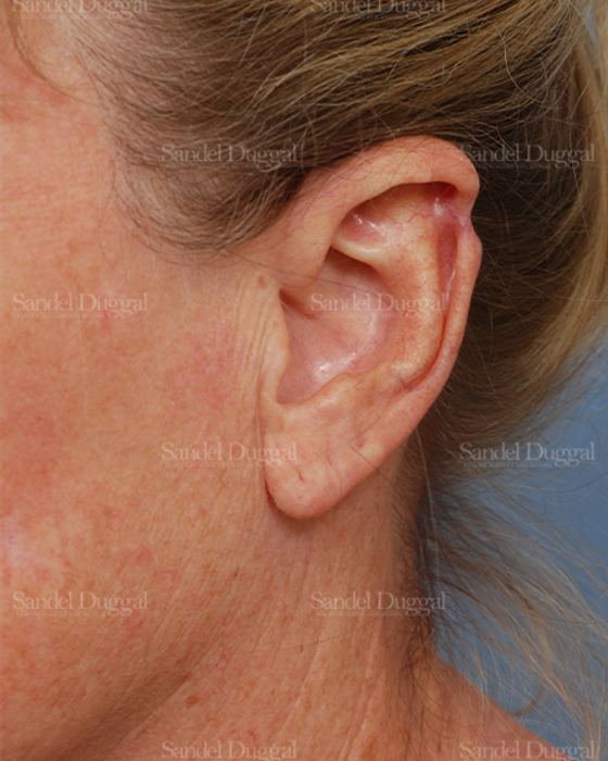 Scar Revision before, case 2570