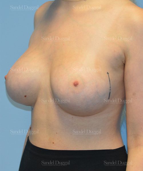 Breast Augmentation after, case 3129
