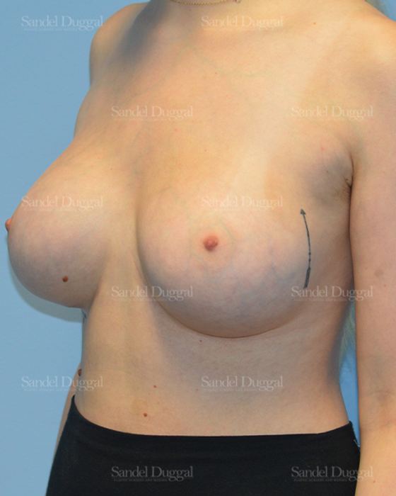 Breast Augmentation after, case 3129