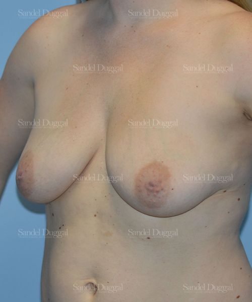 Breast Augmentation with Lift before, case 3428