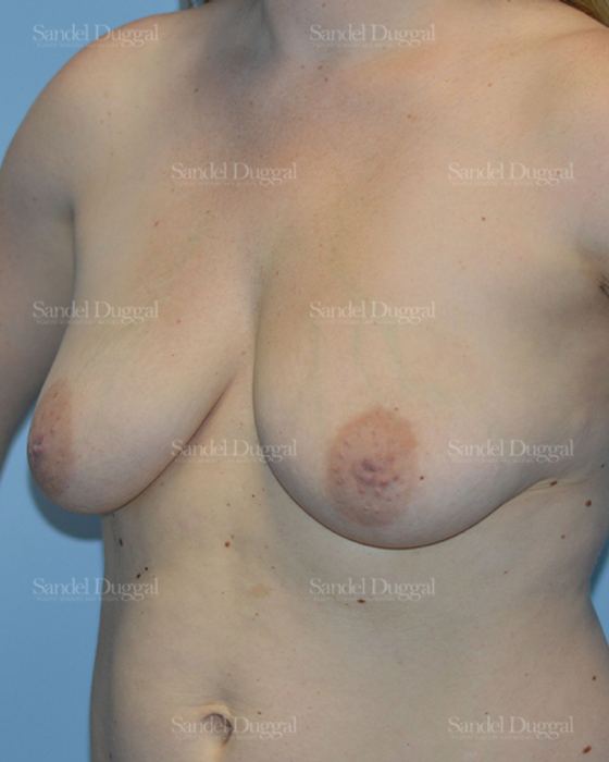 Breast Augmentation with Lift before, case 3428