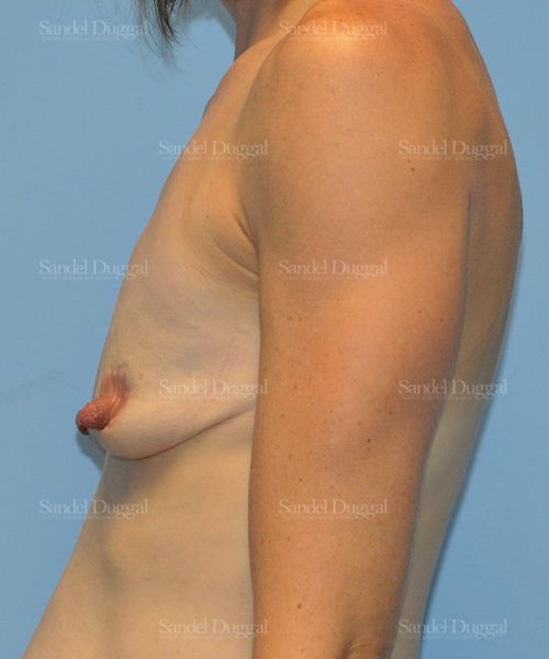 Breast Augmentation with Lift before, case 3400