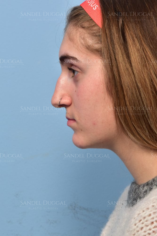 Rhinoplasty before, case 6003