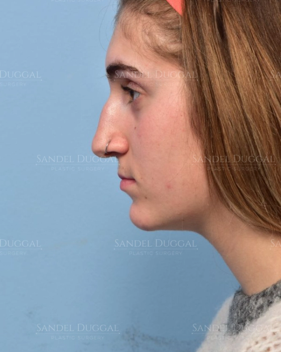 Rhinoplasty before, case 6003