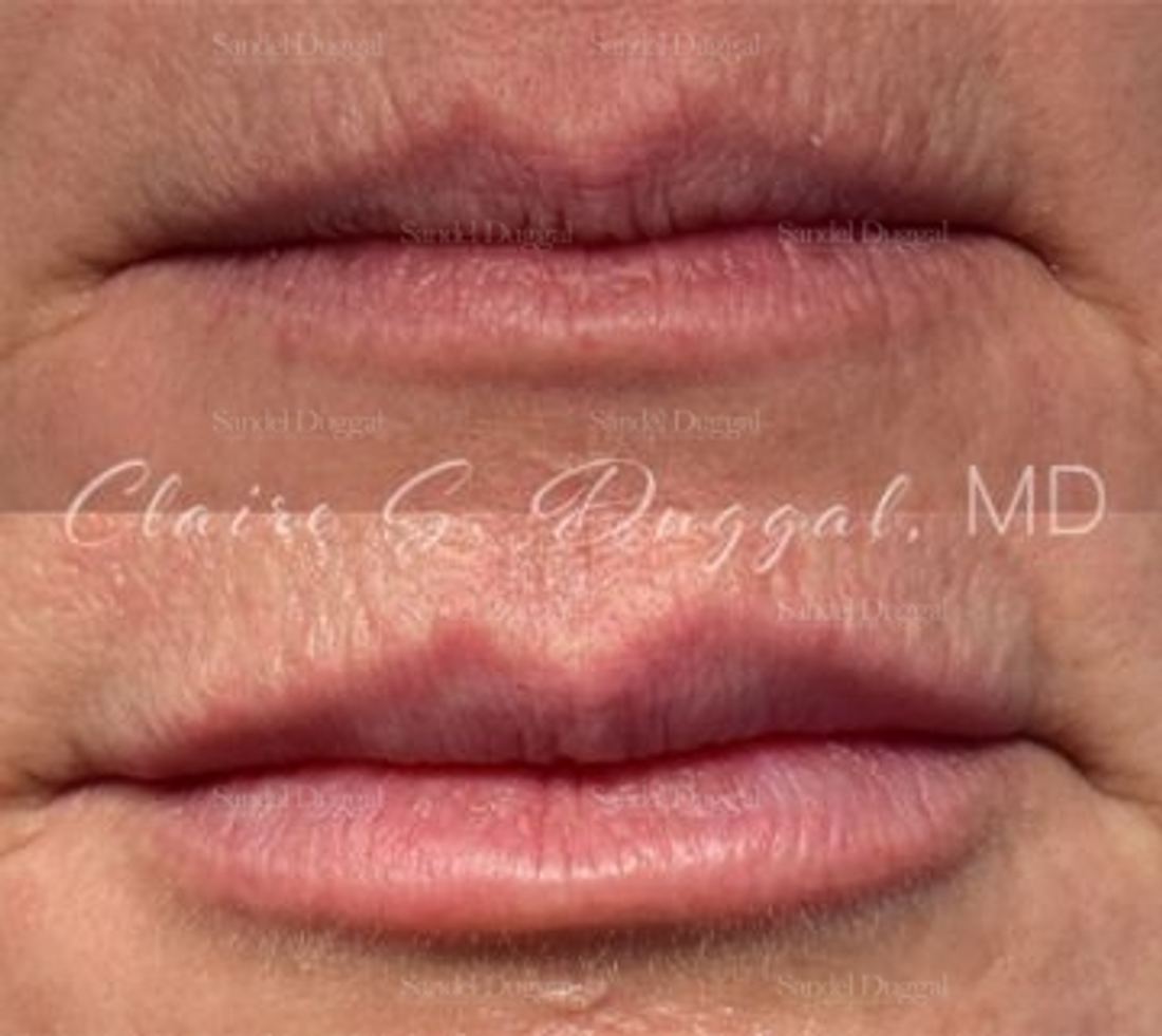 Lip Augmentation / Lip Lift before and after, case 4383