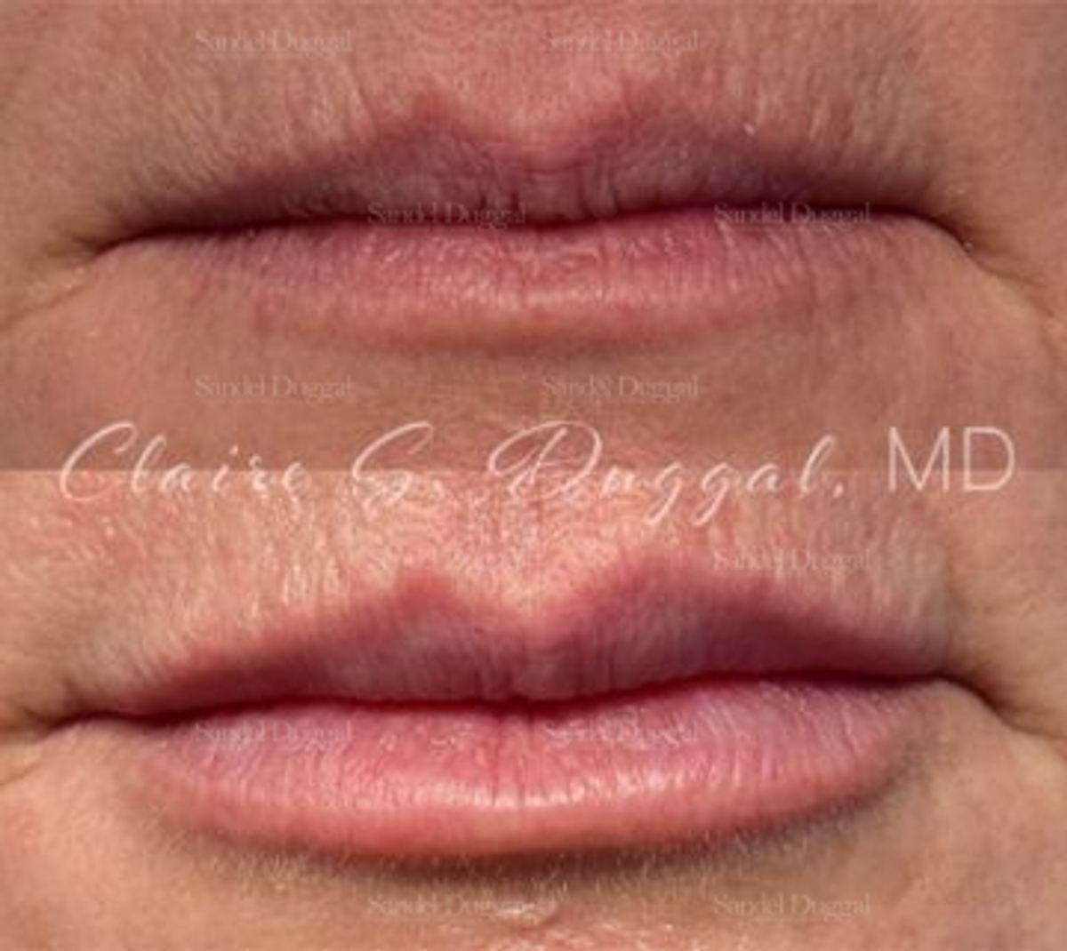 Lip Augmentation / Lip Lift before and after, case 4383