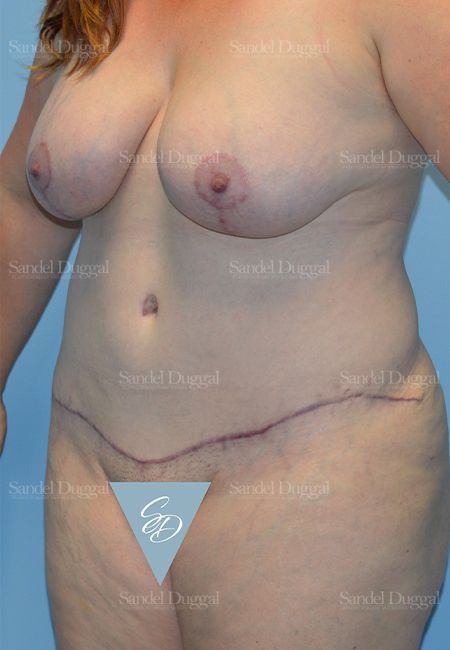Mommy Makeover after, case 2190