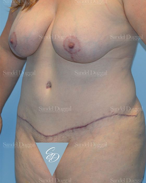 Mommy Makeover after, case 2190