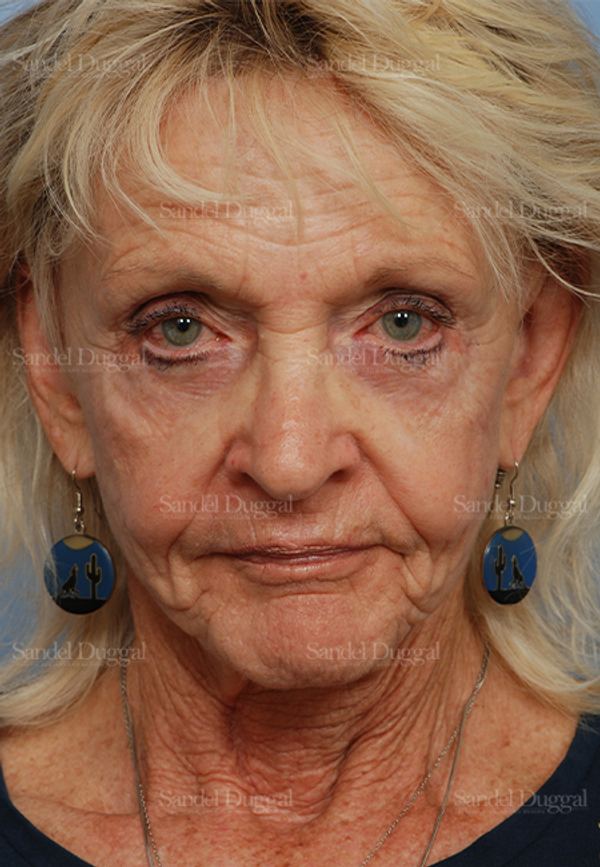 Cheek Augmentation before, case 1446