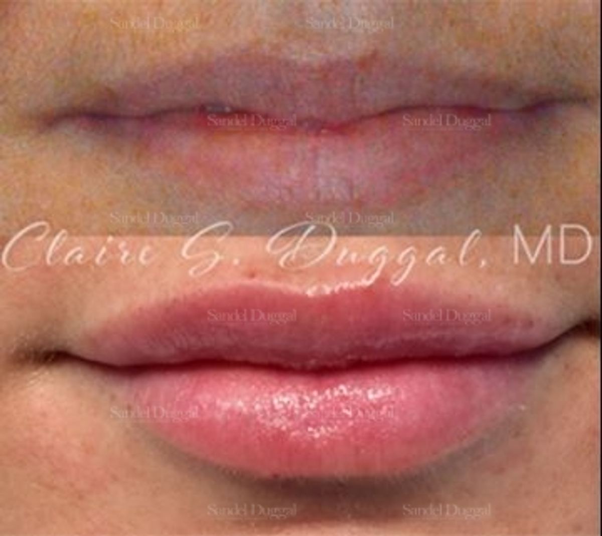 Lip Augmentation / Lip Lift before and after, case 4360