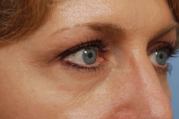 Eyelid Rejuvenation after, case 824