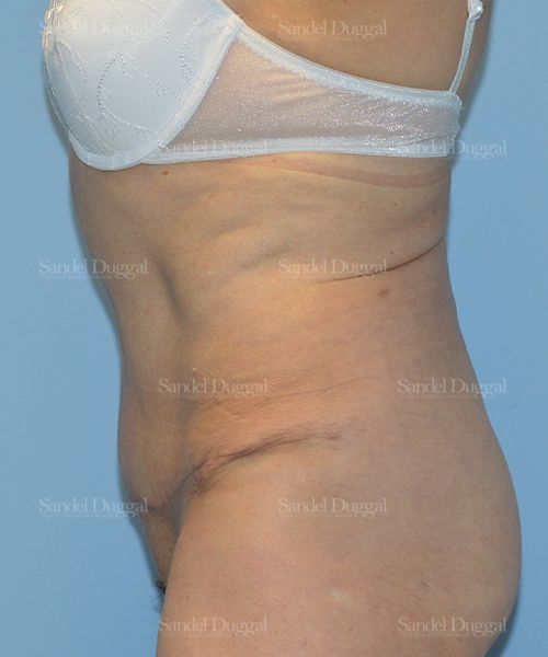 Tummy Tuck after, case 1729