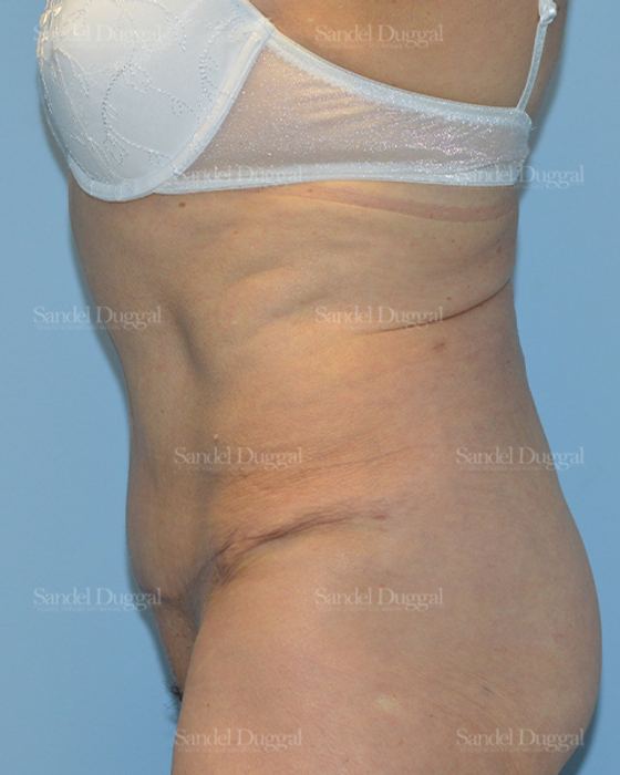 Tummy Tuck after, case 1729