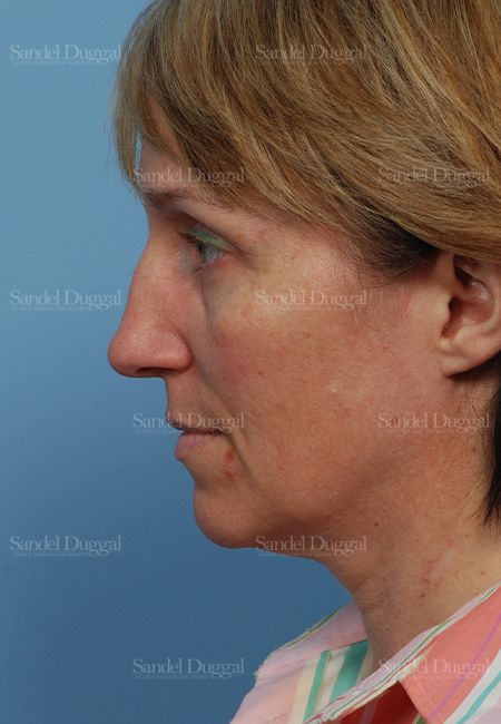 Rhinoplasty before, case 2855