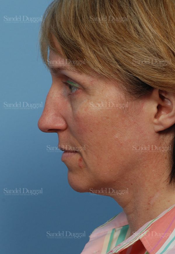 Rhinoplasty before, case 2855