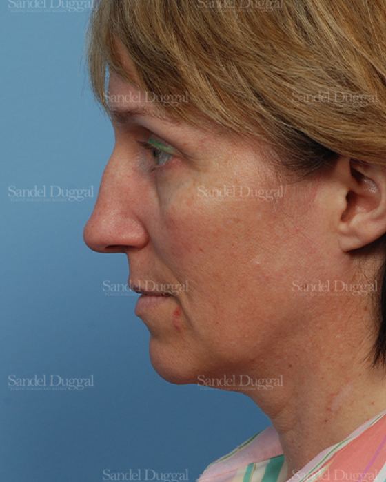 Rhinoplasty before, case 2855