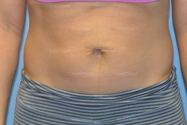 Umbilicoplasty after, case 1457