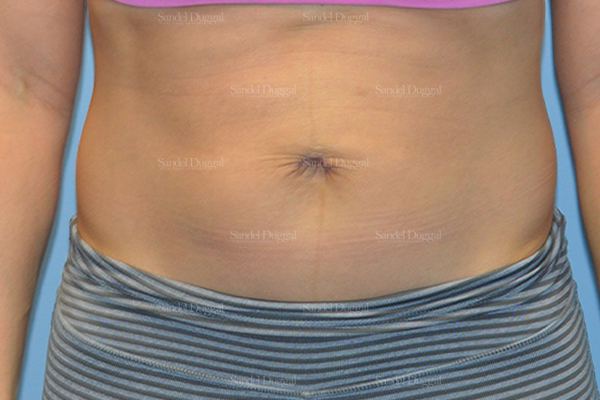 Umbilicoplasty after, case 1457