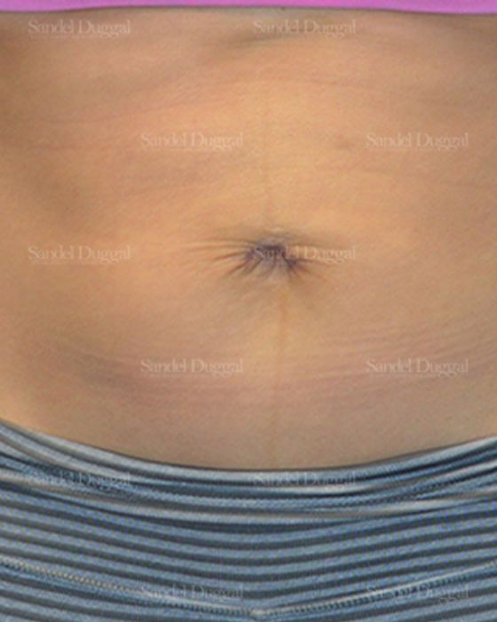 Umbilicoplasty after, case 1457